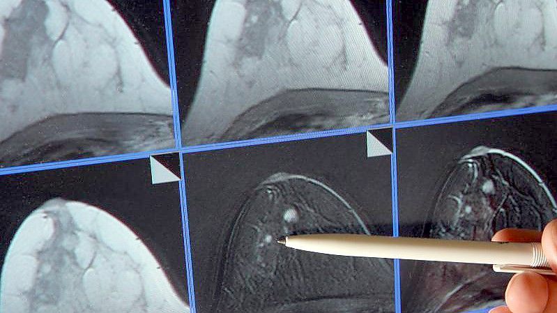 Auf der Bildschirmdarstellung einer Magnetresonanz-(MR)-Mammographie ist ein winziger Tumor in der Brust einer Patientin zu sehen. Foto: Jan-Peter Kasper/dpa-Zentralbild/dpa