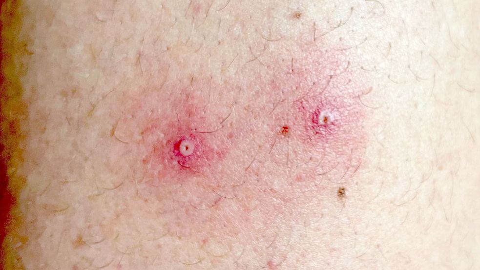 Affenpocken sind zur Notlage erklärt worden. Foto: dpa/Institute of Tropical Medicine, Antwerp