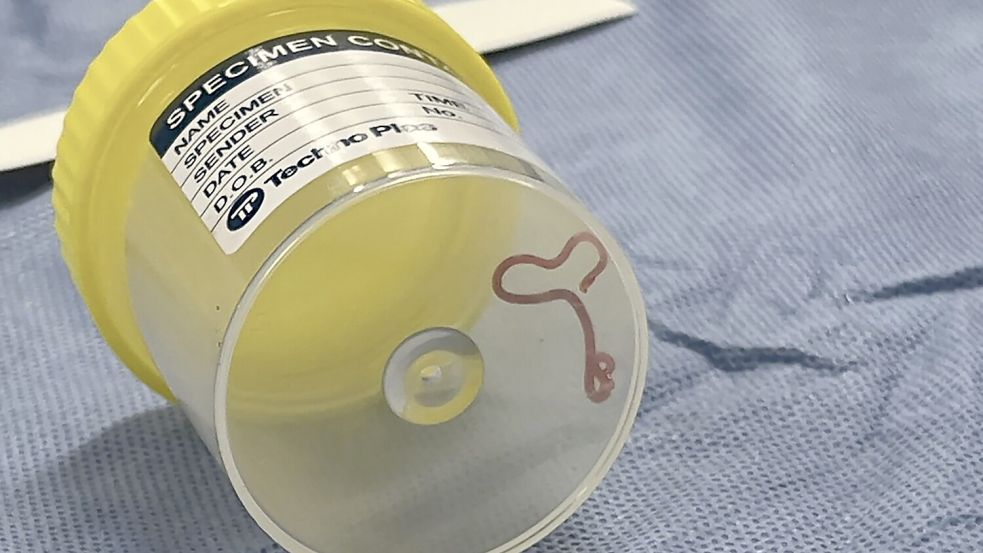 Wurm in Gehirn von Australierin entdeckt Foto: dpa/AP/Canberra Health Services