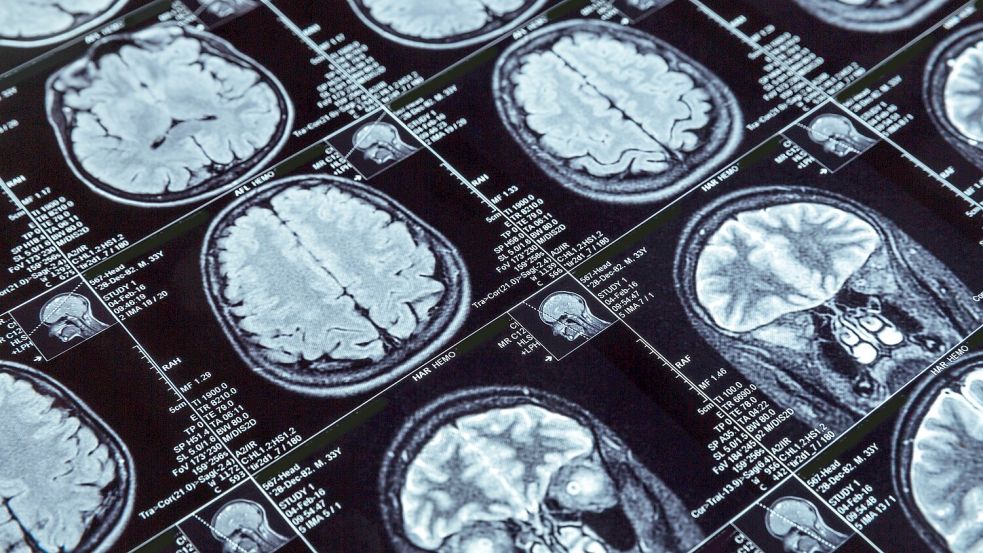 Betroffen von der Krankheit ist das Kleinhirn. Das kann unterschiedlichste Symptome auslösen. Foto: IMAGO / Panthermedia