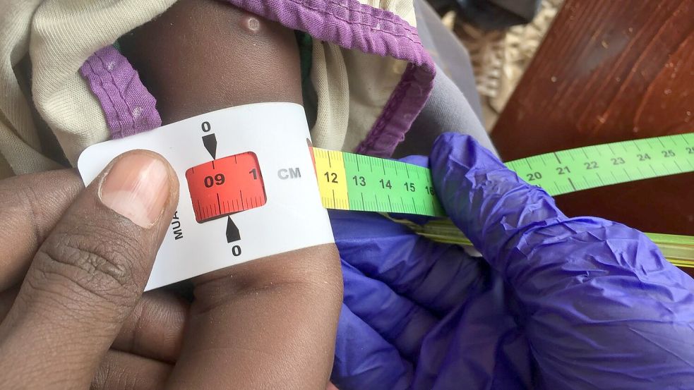 Der Armumfang eines schwer unterernährten Babys in Somalia wird gemessen. (Archivbild) Foto: Eva-Maria Krafczyk/dpa