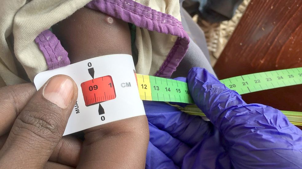 Ein Arzt misst im Sudan den Armumfang eines schwer unterernährten Babys (Archivbild) Foto: Eva-Maria Krafczyk/dpa