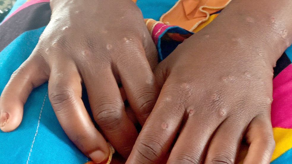Mpox ist vor allem für kleine Kinder und immungeschwächte Menschen gefährlich (Archivbild) Foto: Janvier Barhahiga/AP/dpa