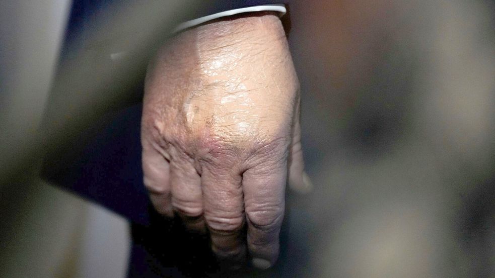 Nachdem der Bluterguss am Handrücken für Aufsehen sorgte, wurde er häufig bei Auftritten zugeschminkt. (Archivbild) Foto: Julia Demaree Nikhinson/AP/dpa