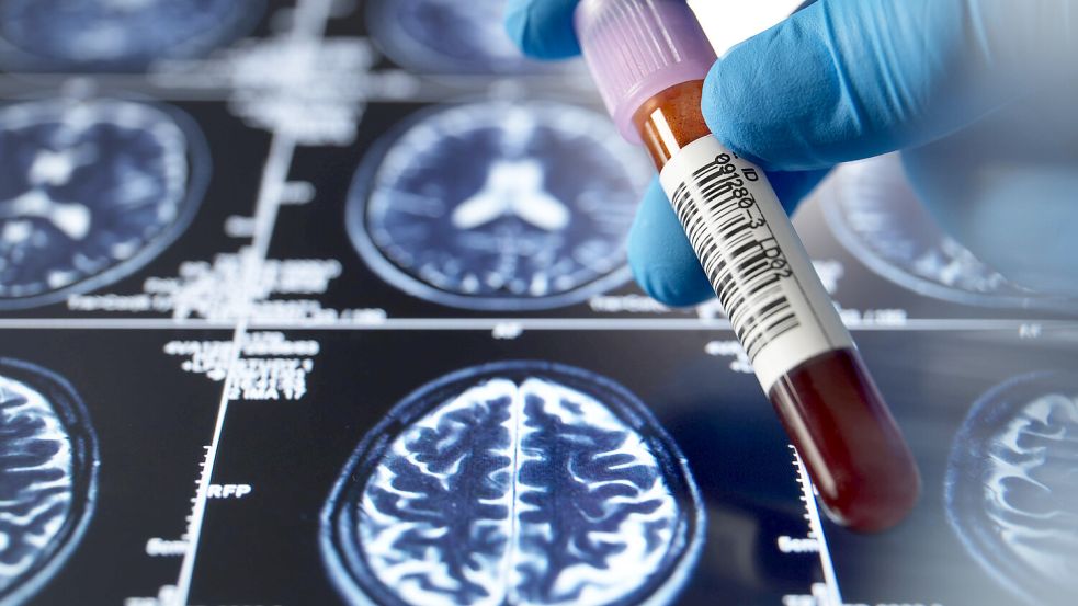 Blutprobe und Gehirn-MRT im Kontext der neurologischen Demenzforschung. Foto: IMAGO/Westend61