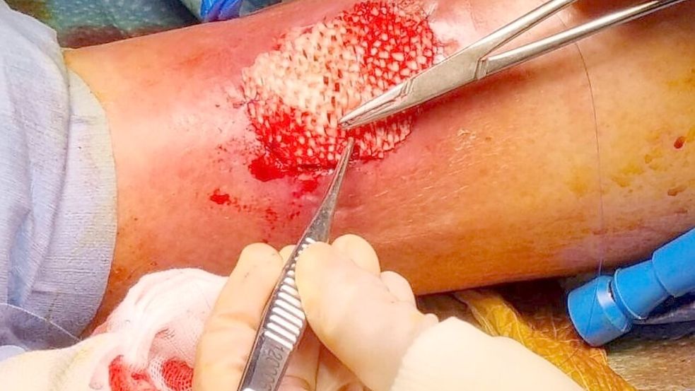 Das Omega-3 in der Fischhaut fördert die Heilung großer Wunden. Foto: Saziye Karaca/-/dpa