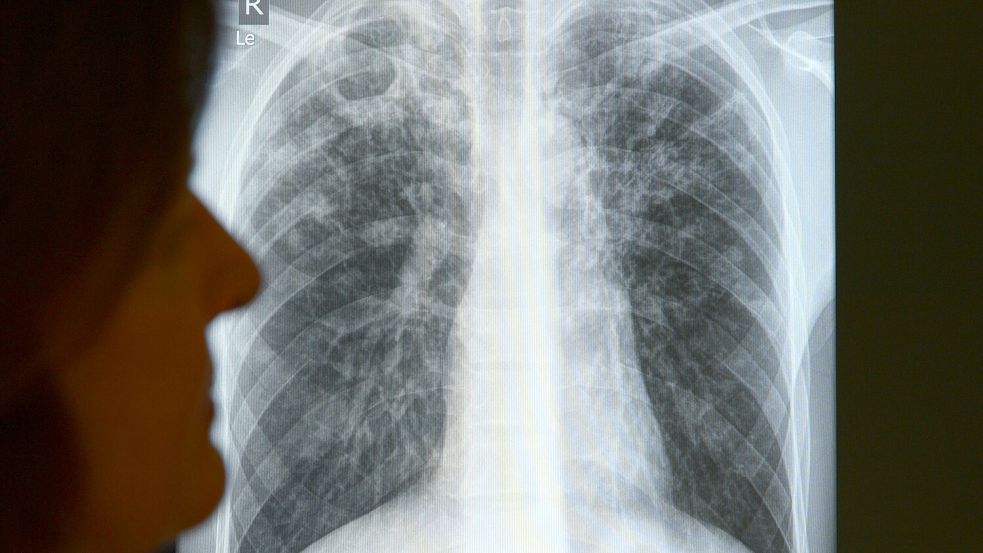 Bis zu 100.000 Euro muss der Landkreis Cloppenburg für die Quarantäne eines Tuberkulose-Patienten zahlen. Foto: dpa/Rainer Jensen