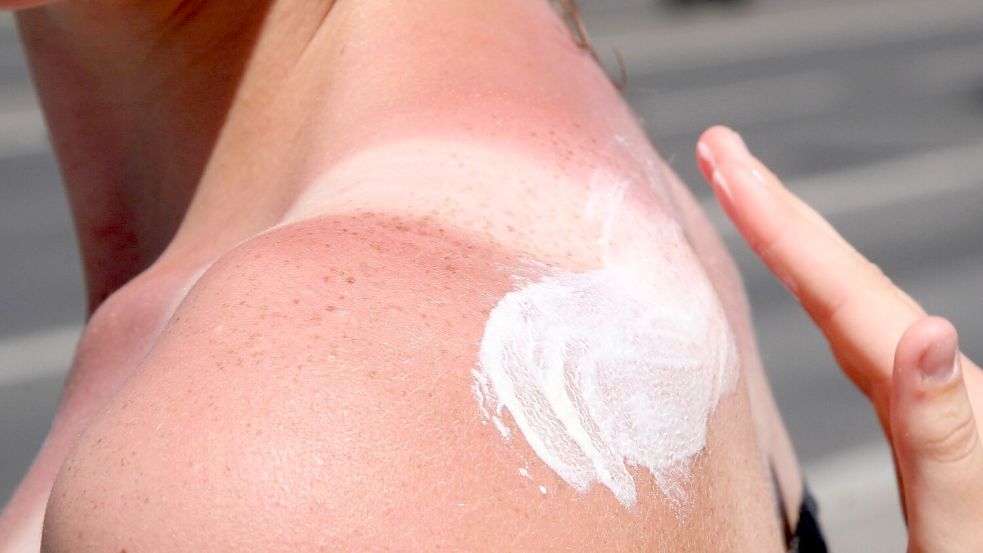 Sonnenbrand ist gefährlich - es drohen Langzeitfolgen. Foto: Stephanie Pilick