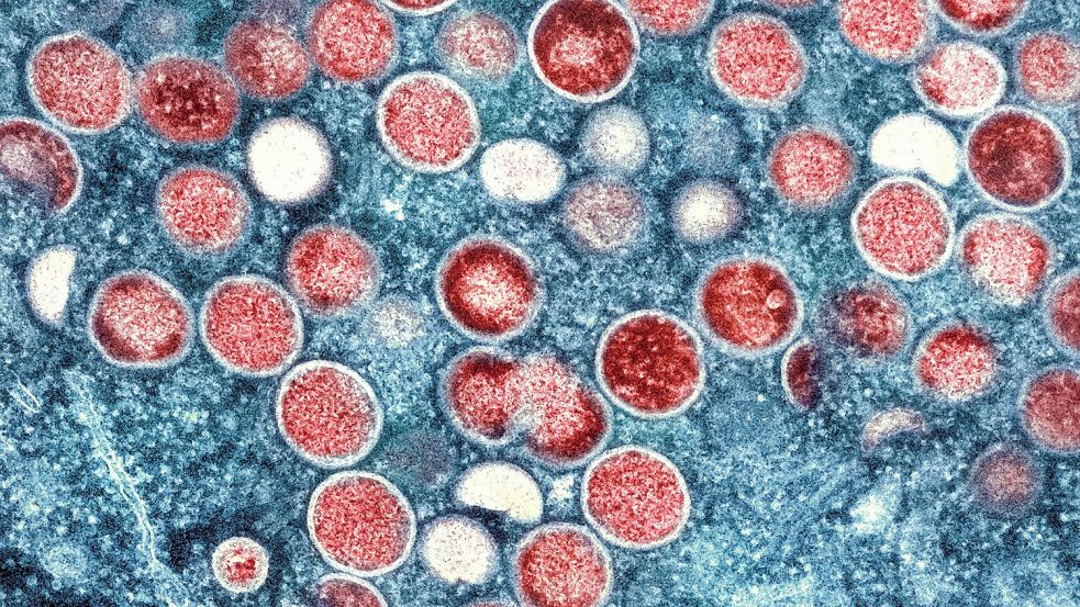 Die eitrigen Pusteln können am ganzen Körper auftreten und sehr schmerzhaft sein. (Symbolbild) Foto: -/National Institute of Allergy