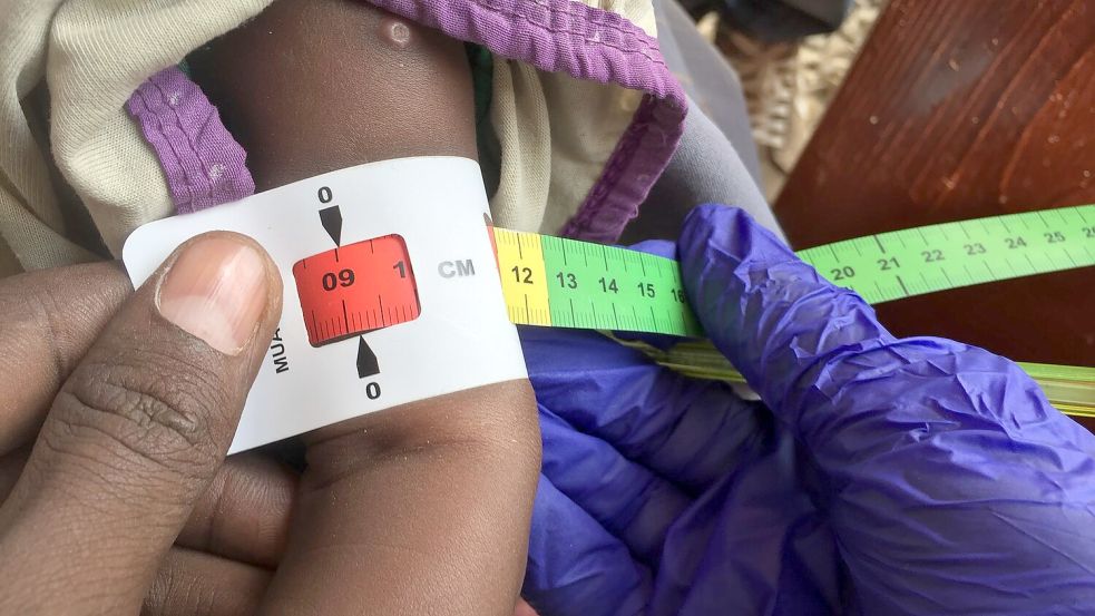 Schon jetzt gelten fast zwei Millionen Kinder in Somalia akut unterernährt. (Archivbild) Foto: Eva-Maria Krafczyk/dpa